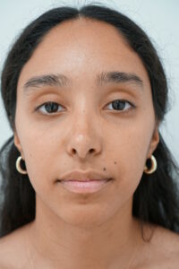 Ultrasonic Rhinoplasty