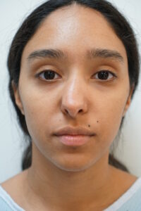 rhinoplasty