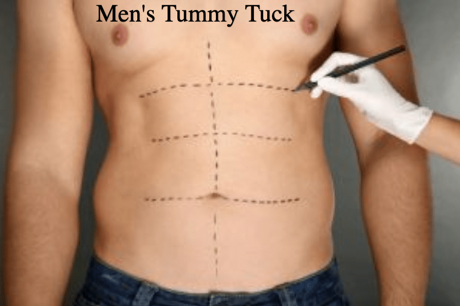Dr-Salomon-Tummy-Tuck-Picture-3