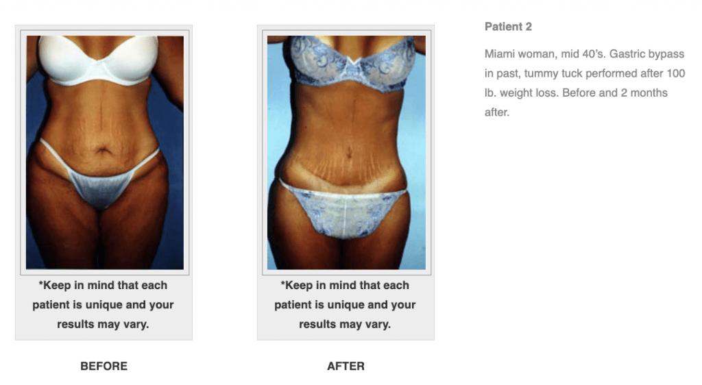 How Many Sizes Do You Lose With a Tummy Tuck? - OptimalSelf MD